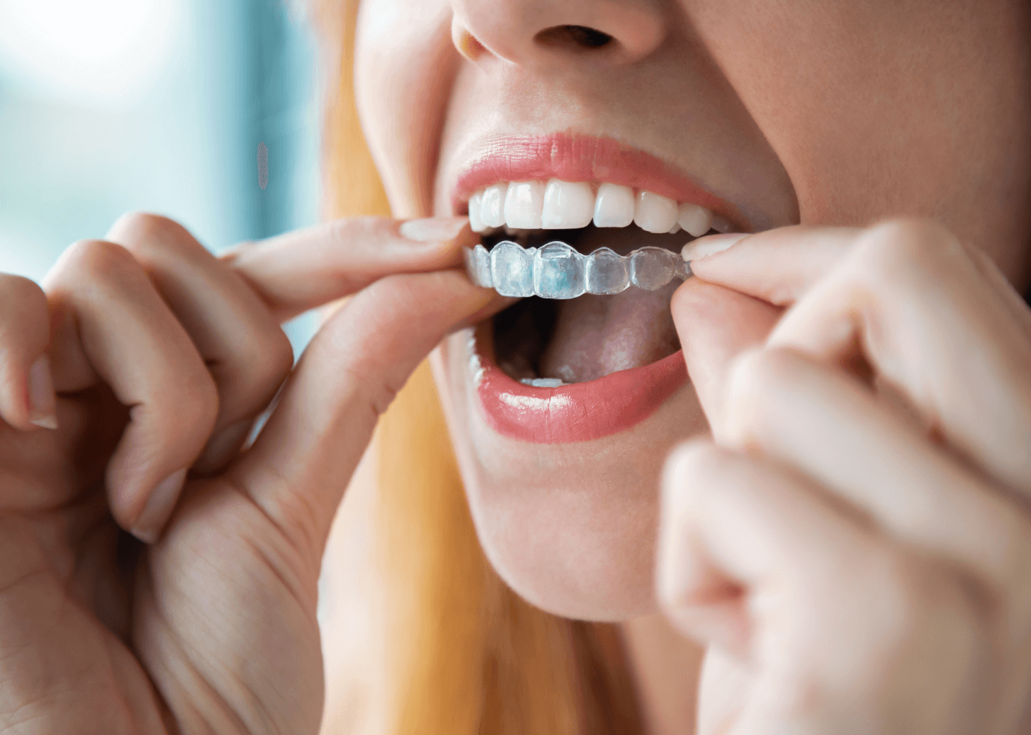 Invisalign aligners being put in mouth.