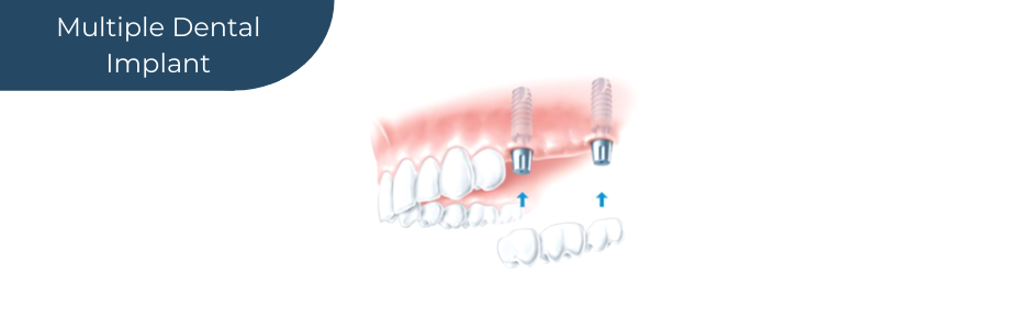 Diagram showing how multiple dental implants work
