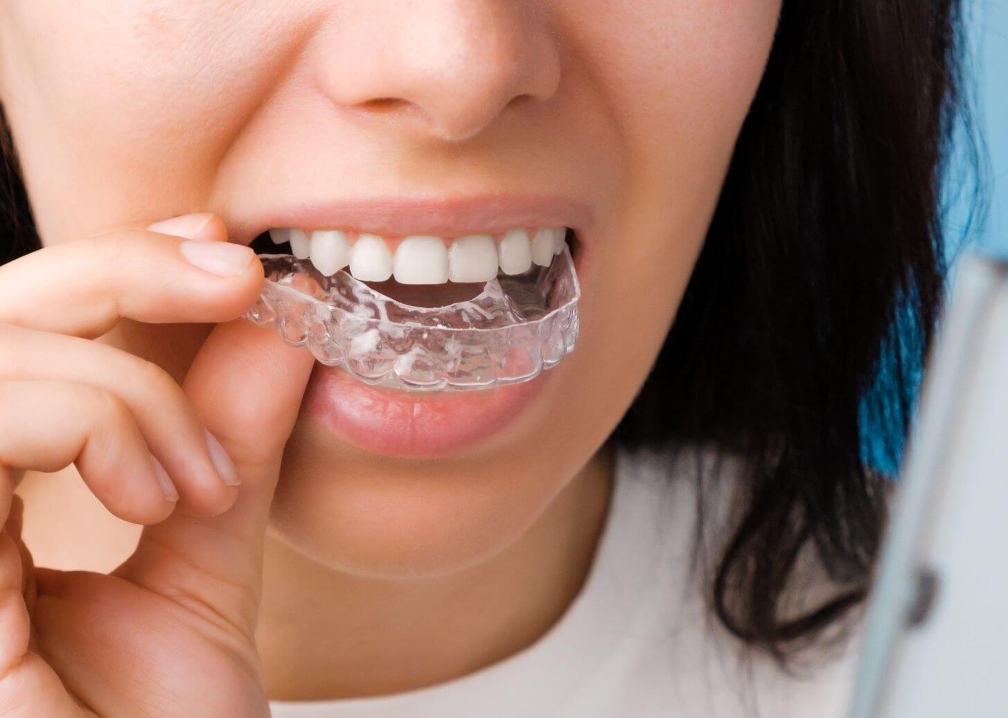 Close up image of lady putting in her clear aligners