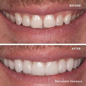 Image of two set of teeth demonstrating the before and after, when having porcelain veneers