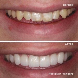 Image of two set of teeth demonstrating the before and after, when having porcelain veneers. Ladies teeth.