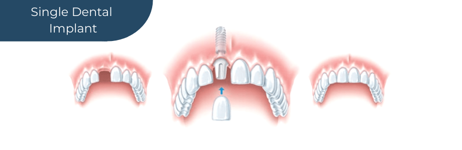 Diagram of Single Dental Implants in Tunbridge Wells